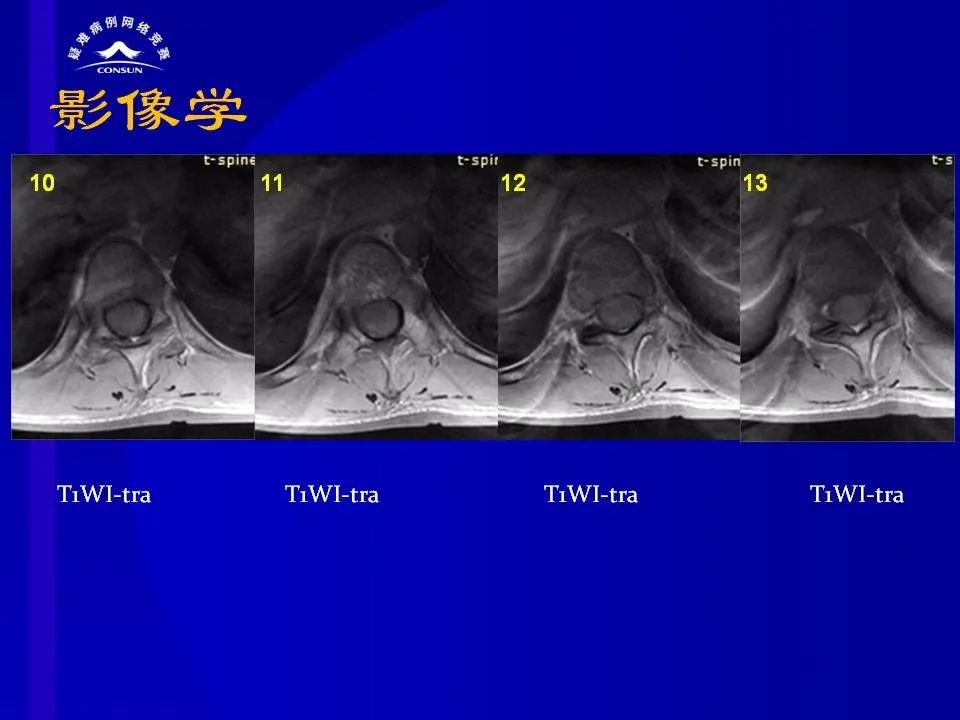 【病例】脊髓节细胞胶质瘤1例MR影像解析 【病例】脊髓节细胞胶质瘤1例MR影像解析