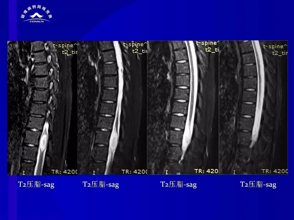 【病例】脊髓节细胞胶质瘤1例MR影像解析 【病例】脊髓节细胞胶质瘤1例MR影像解析