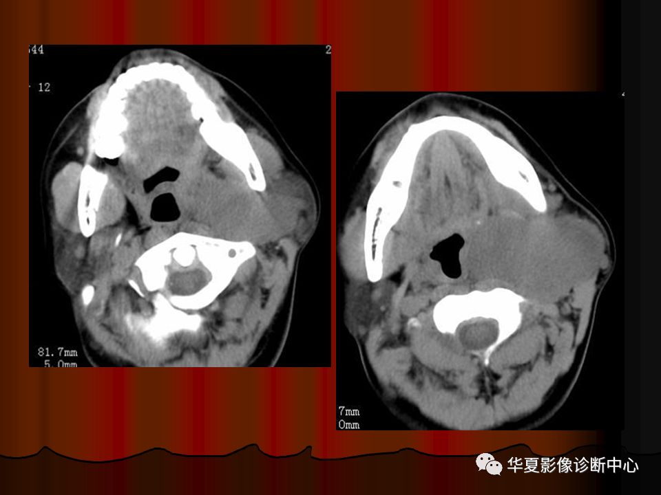 【PPT】口腔颌面部CT诊断