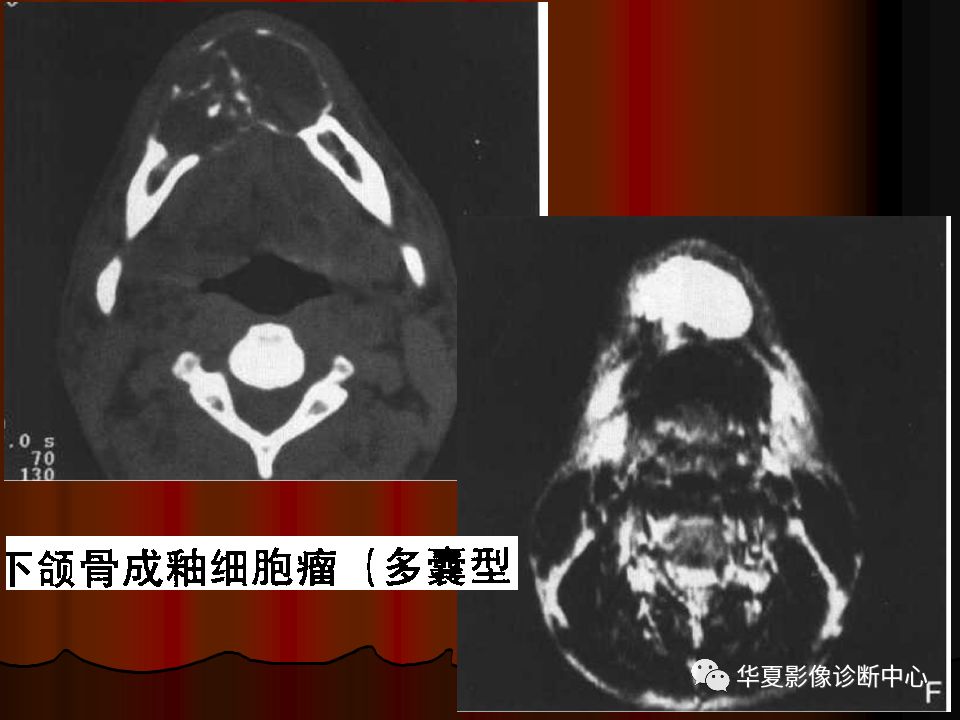 【PPT】口腔颌面部CT诊断
