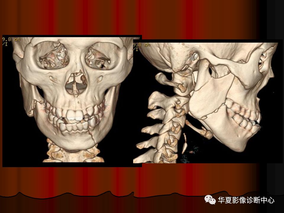 【PPT】口腔颌面部CT诊断