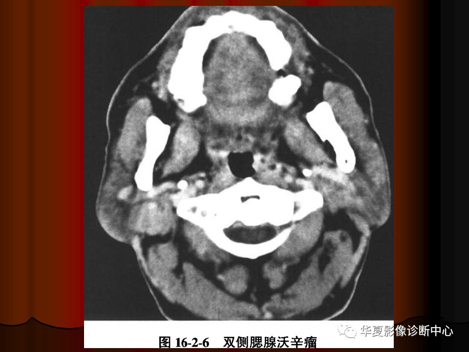 【PPT】口腔颌面部CT诊断