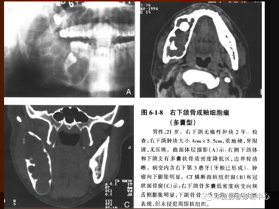 【PPT】口腔颌面部CT诊断