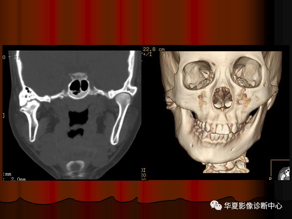 【PPT】口腔颌面部CT诊断