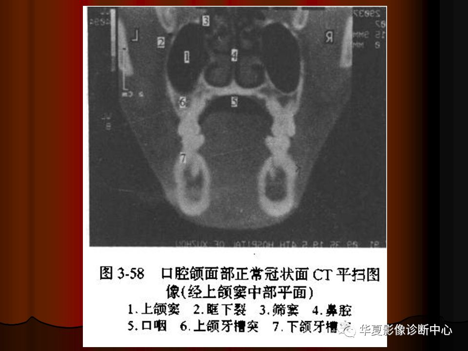 【PPT】口腔颌面部CT诊断