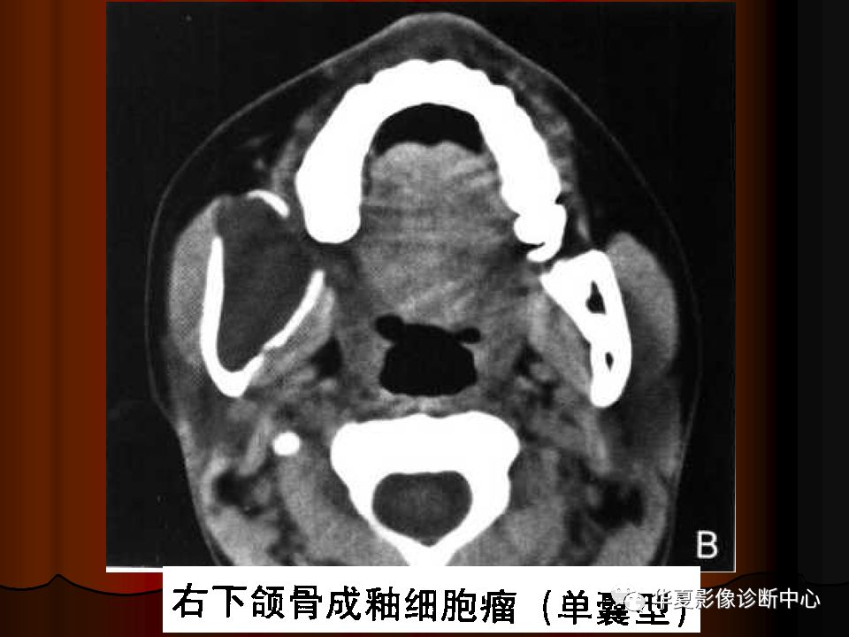 【PPT】口腔颌面部CT诊断