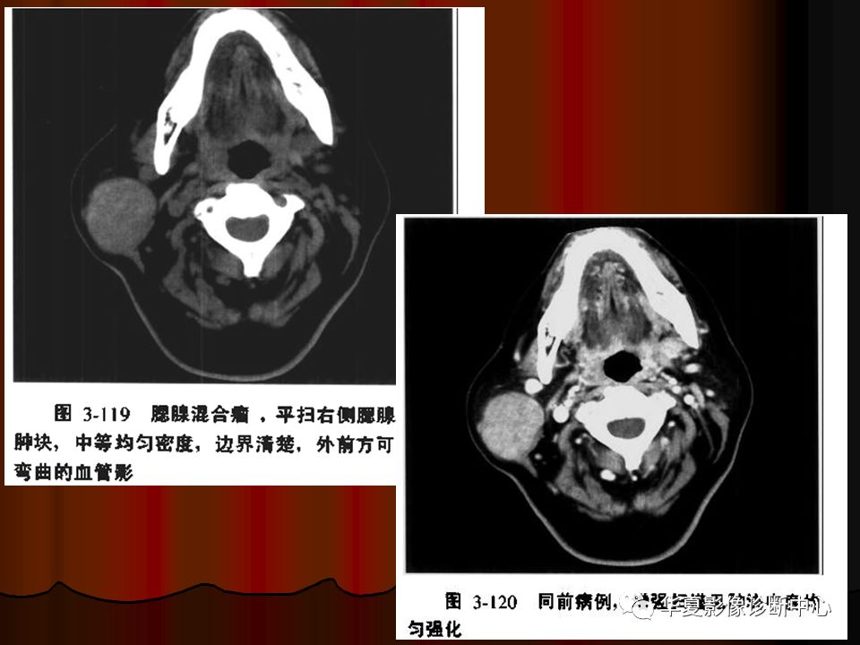 【PPT】口腔颌面部CT诊断