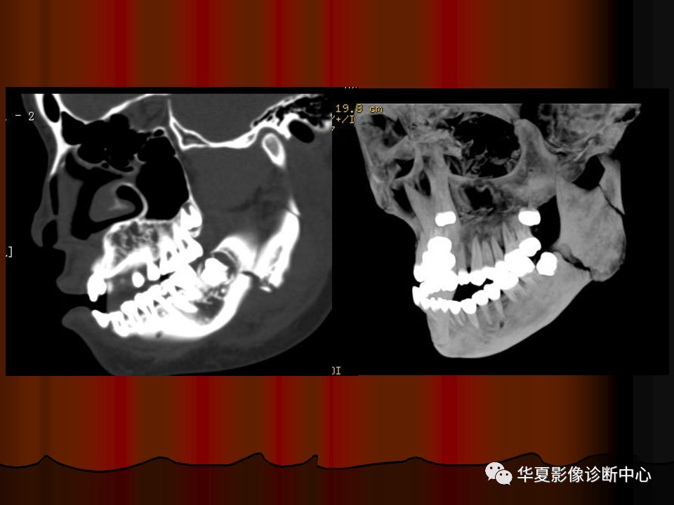 【PPT】口腔颌面部CT诊断