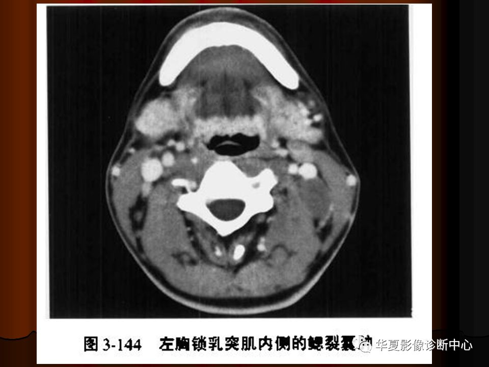 【PPT】口腔颌面部CT诊断