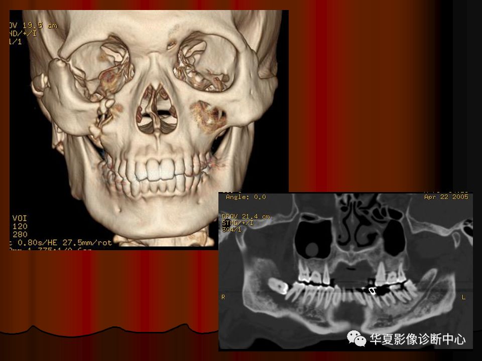 【PPT】口腔颌面部CT诊断