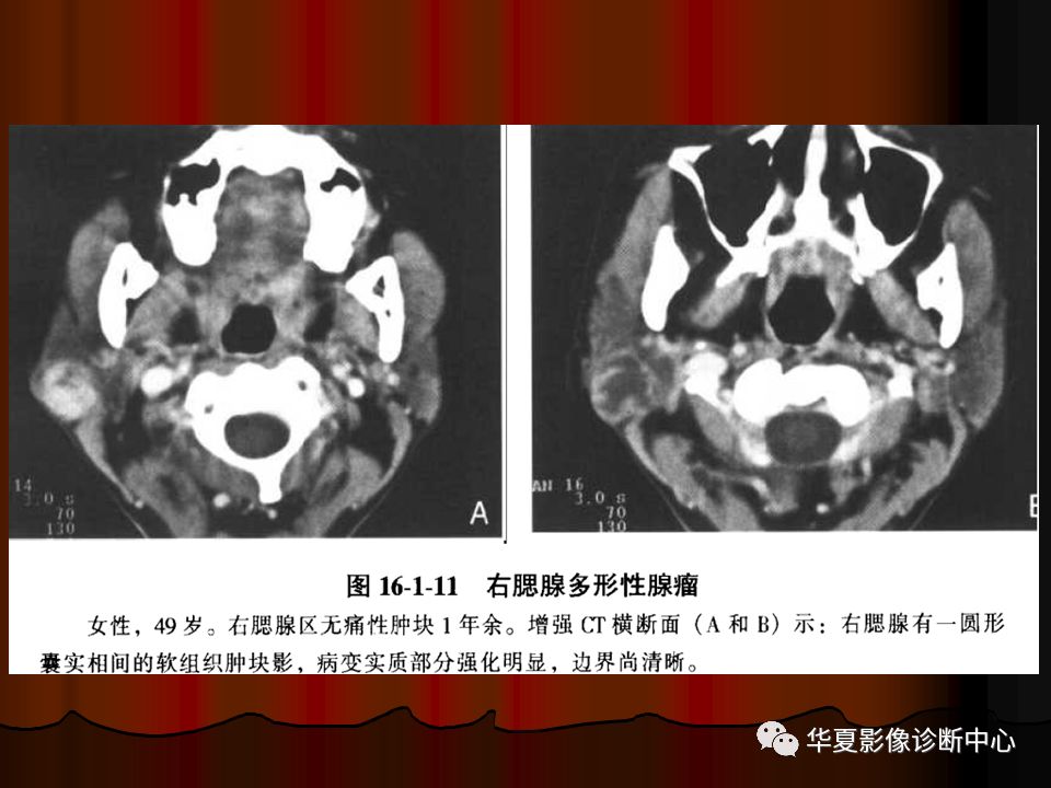 【PPT】口腔颌面部CT诊断