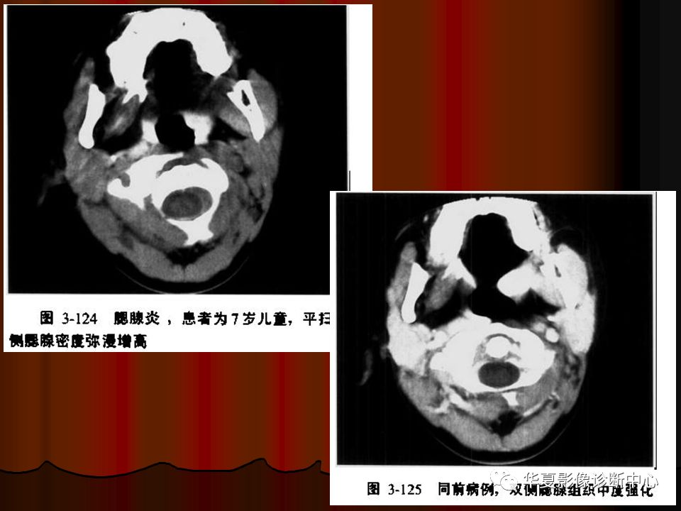 【PPT】口腔颌面部CT诊断