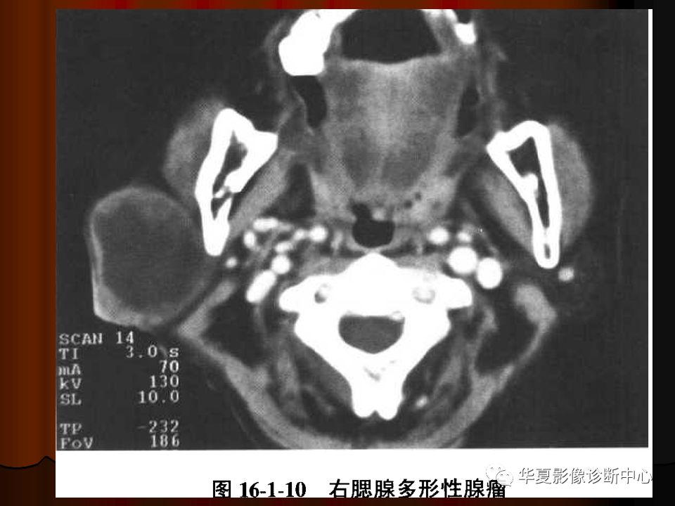 【PPT】口腔颌面部CT诊断