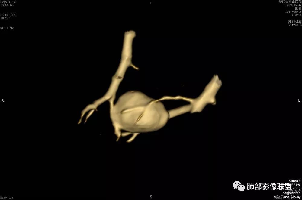 【病例】一眼识破的肺部新生物4例CT影像