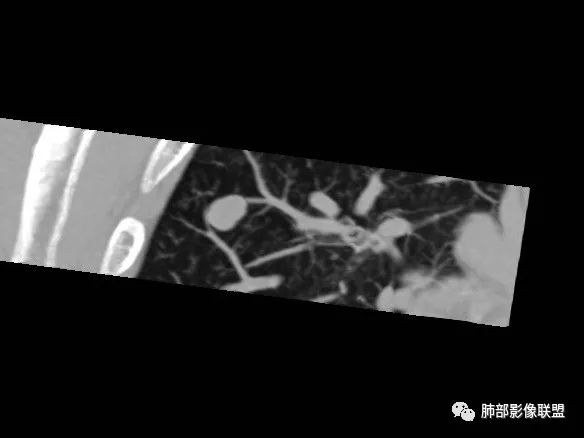 【病例】一眼识破的肺部新生物4例CT影像