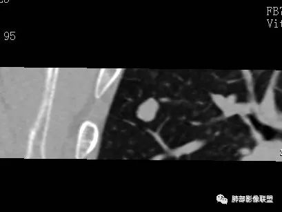 【病例】一眼识破的肺部新生物4例CT影像