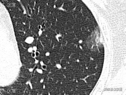【病例】一眼识破的肺部新生物4例CT影像