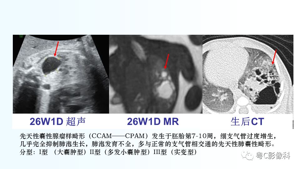 【PPT】儿童胸部影像诊断*基础病变