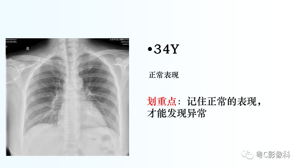 【PPT】儿童胸部影像诊断*基础病变