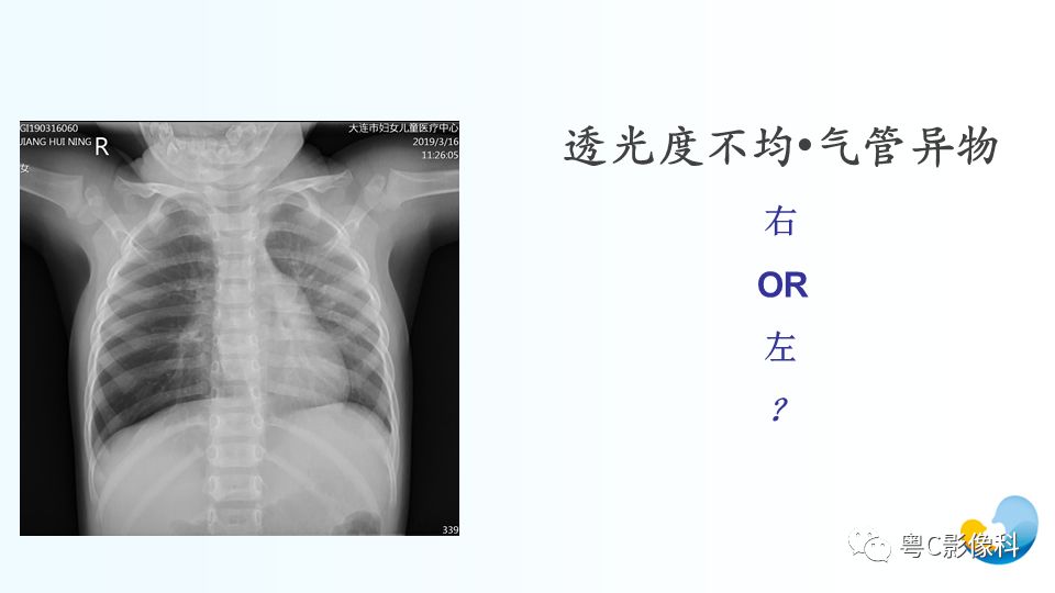 【PPT】儿童胸部影像诊断*基础病变