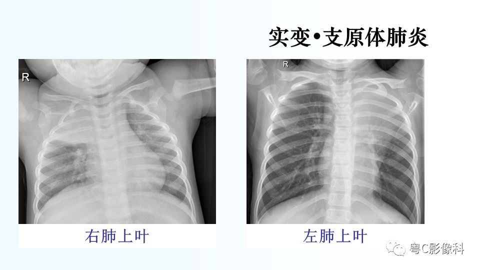 【PPT】儿童胸部影像诊断*基础病变