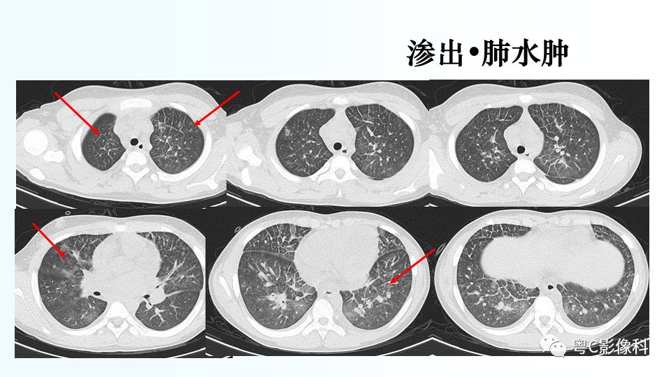【PPT】儿童胸部影像诊断*基础病变