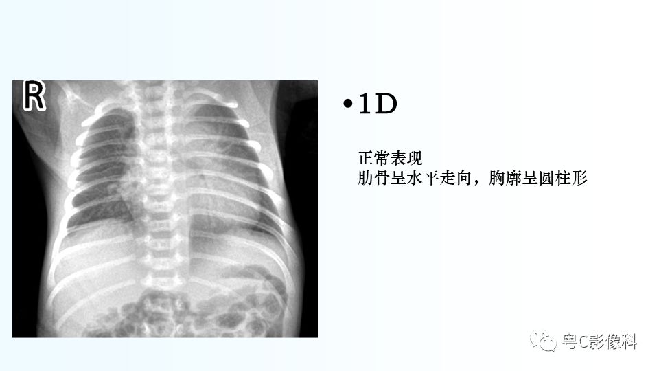 【PPT】儿童胸部影像诊断*基础病变