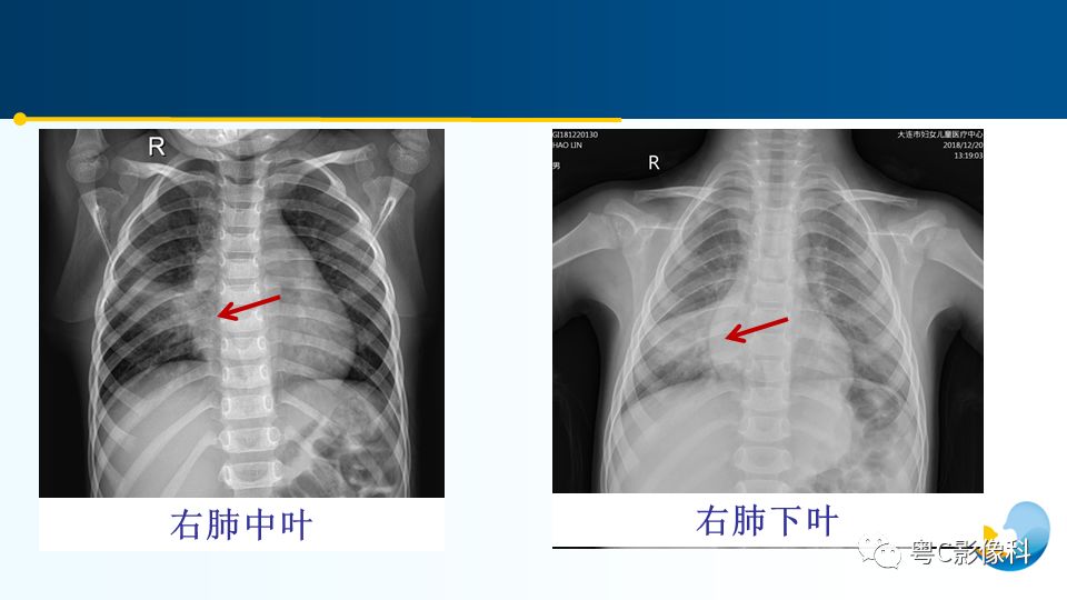 【PPT】儿童胸部影像诊断*基础病变