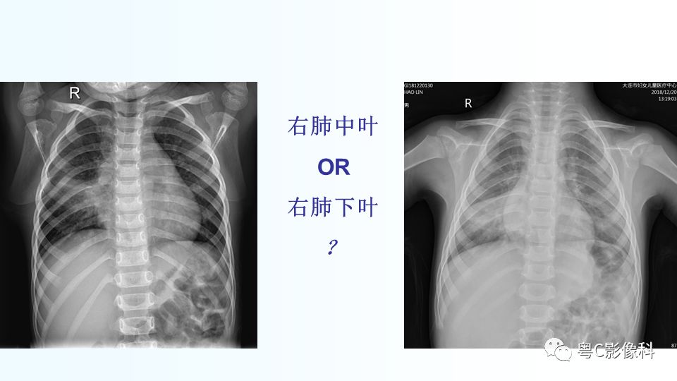 【PPT】儿童胸部影像诊断*基础病变