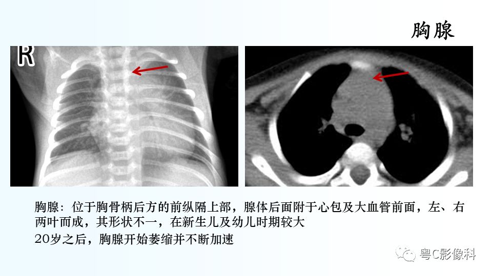 【PPT】儿童胸部影像诊断*基础病变