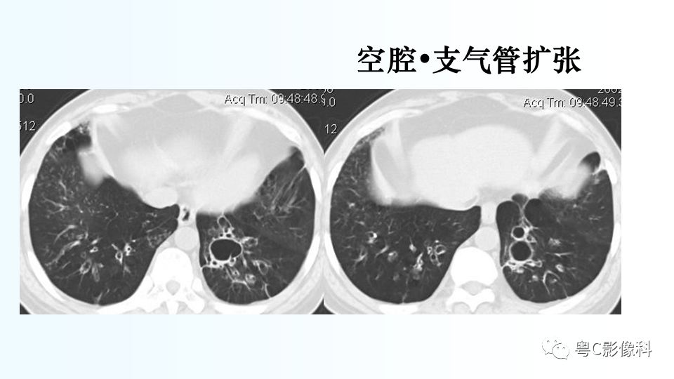 【PPT】儿童胸部影像诊断*基础病变
