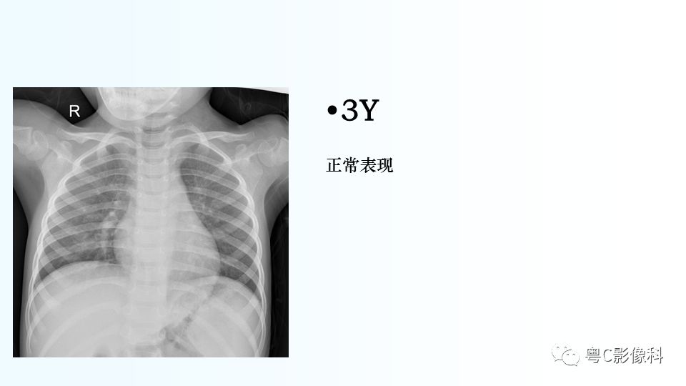 【PPT】儿童胸部影像诊断*基础病变