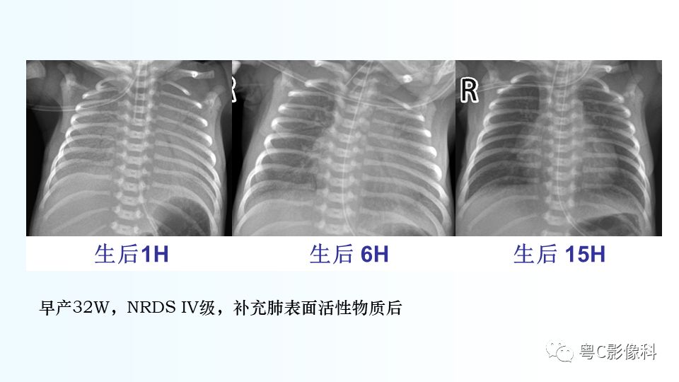 【PPT】儿童胸部影像诊断*基础病变