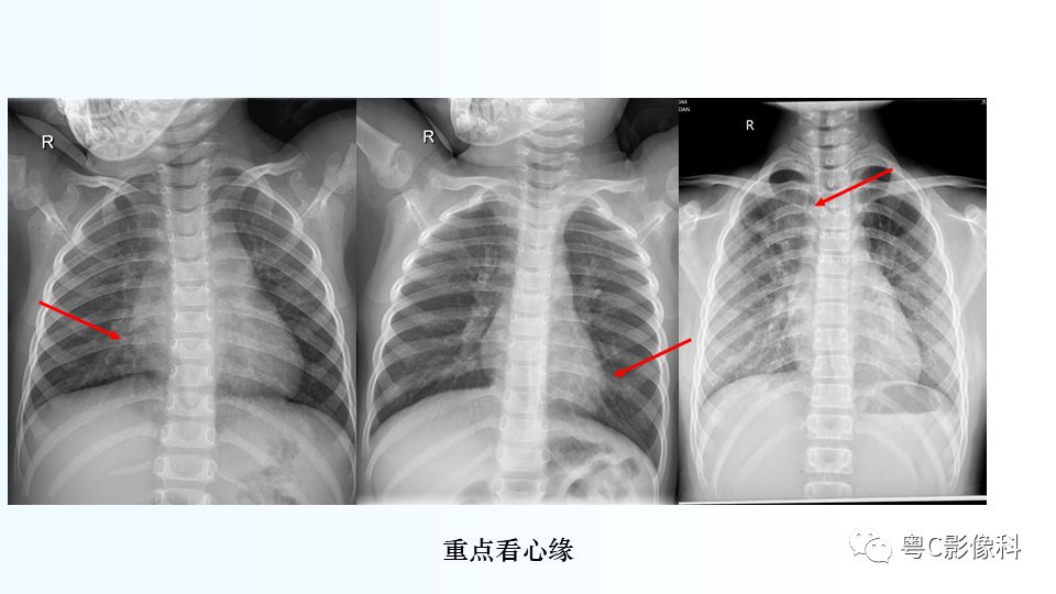 【PPT】儿童胸部影像诊断*基础病变