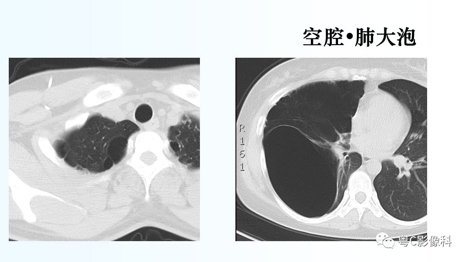 【PPT】儿童胸部影像诊断*基础病变