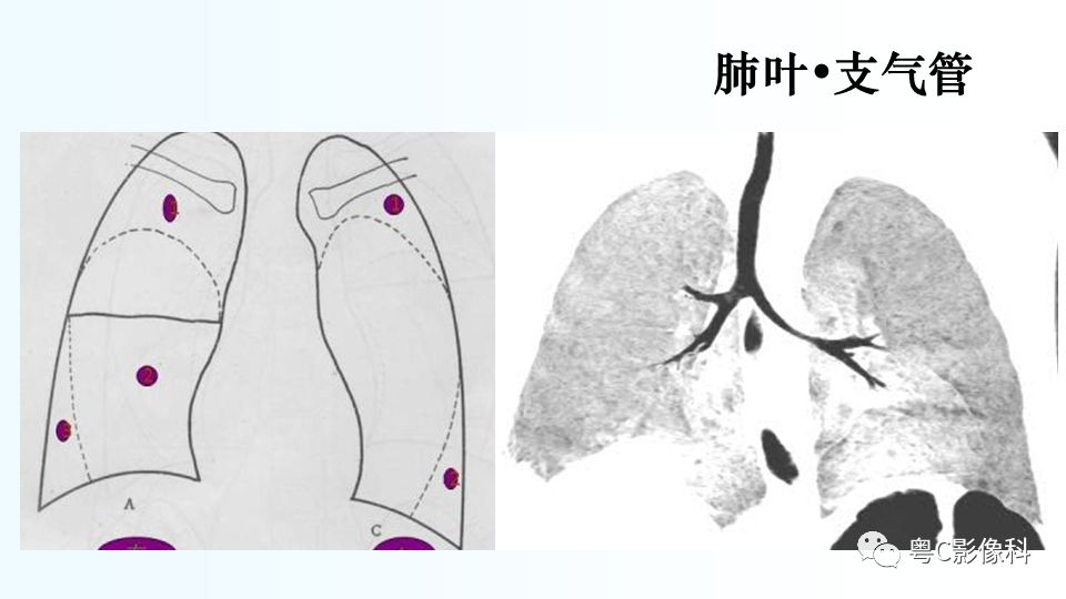 【PPT】儿童胸部影像诊断*基础病变