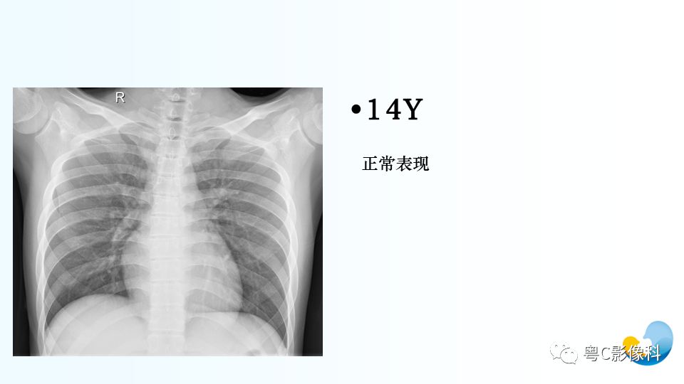 【PPT】儿童胸部影像诊断*基础病变