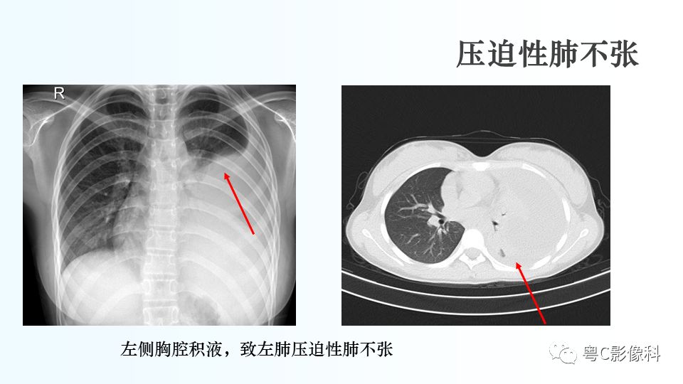 【PPT】儿童胸部影像诊断*基础病变