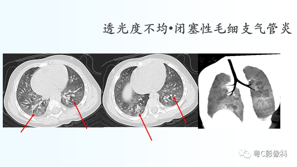 【PPT】儿童胸部影像诊断*基础病变