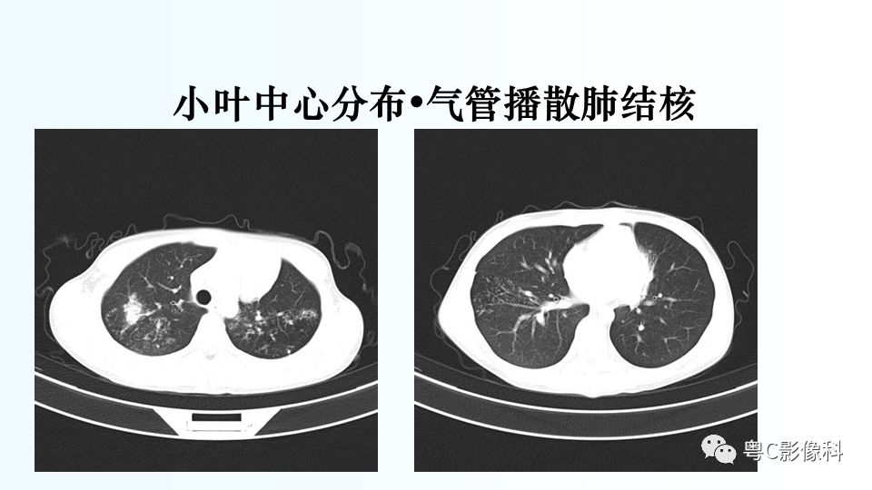 【PPT】儿童胸部影像诊断*基础病变