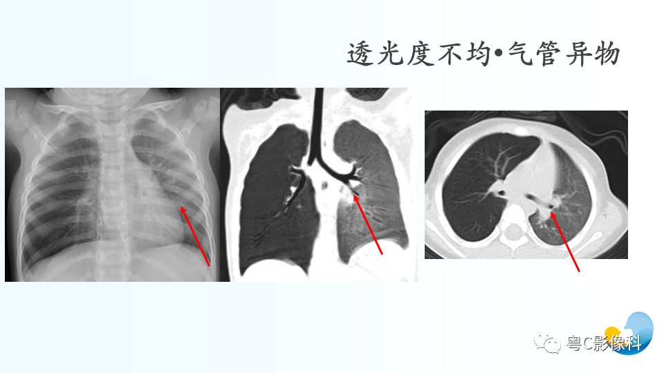 【PPT】儿童胸部影像诊断*基础病变