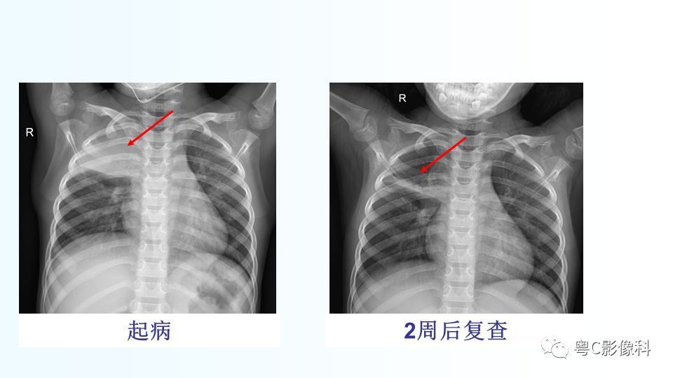 【PPT】儿童胸部影像诊断*基础病变