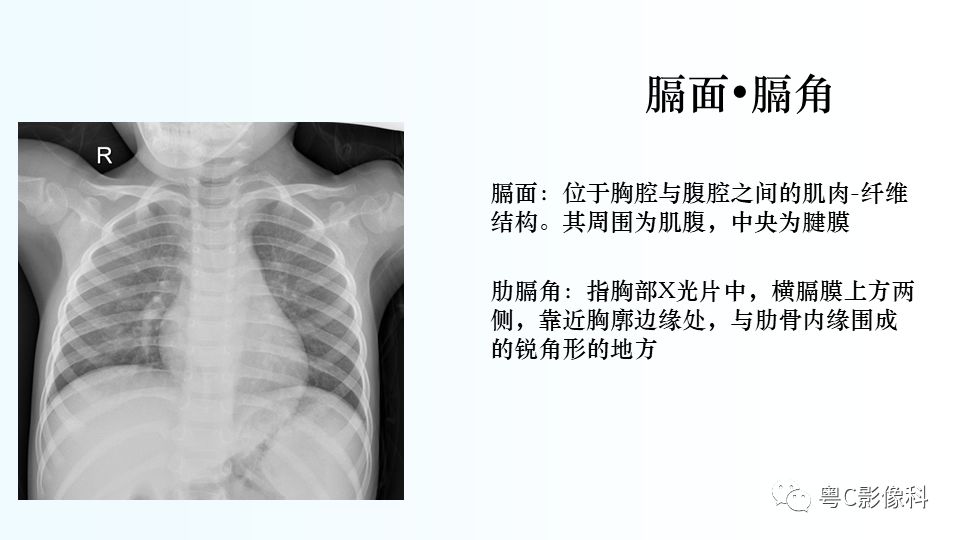 【PPT】儿童胸部影像诊断*基础病变