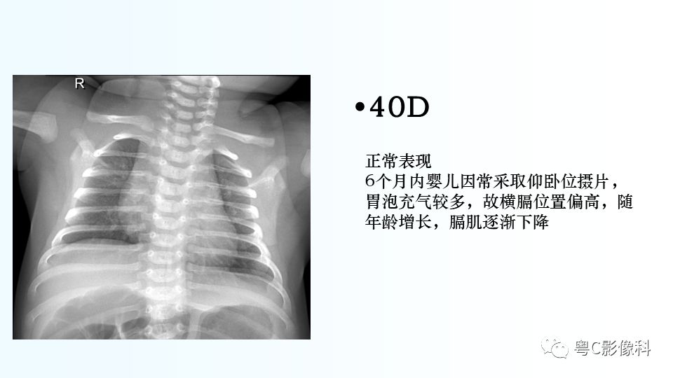 【PPT】儿童胸部影像诊断*基础病变