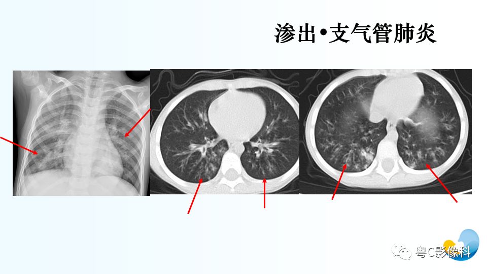 【PPT】儿童胸部影像诊断*基础病变