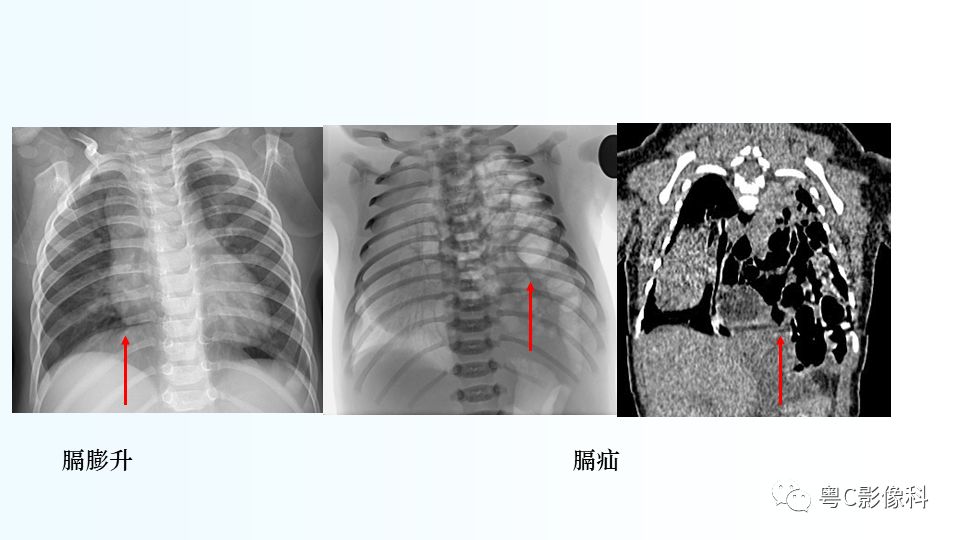 【PPT】儿童胸部影像诊断*基础病变