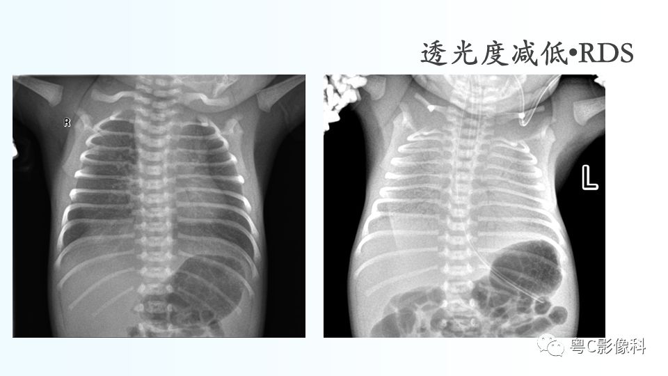 【PPT】儿童胸部影像诊断*基础病变