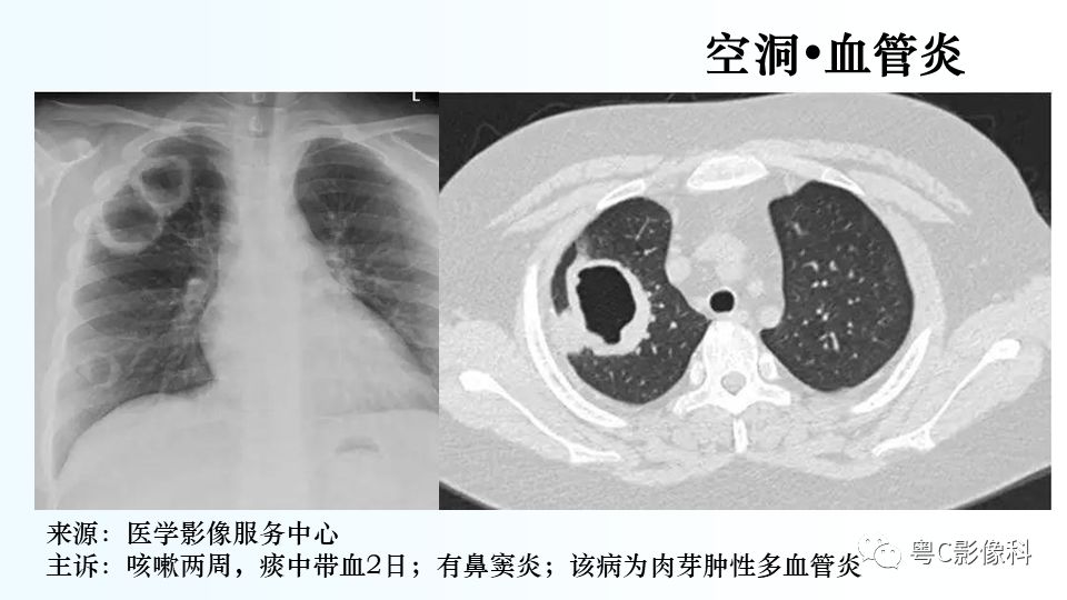 【PPT】儿童胸部影像诊断*基础病变