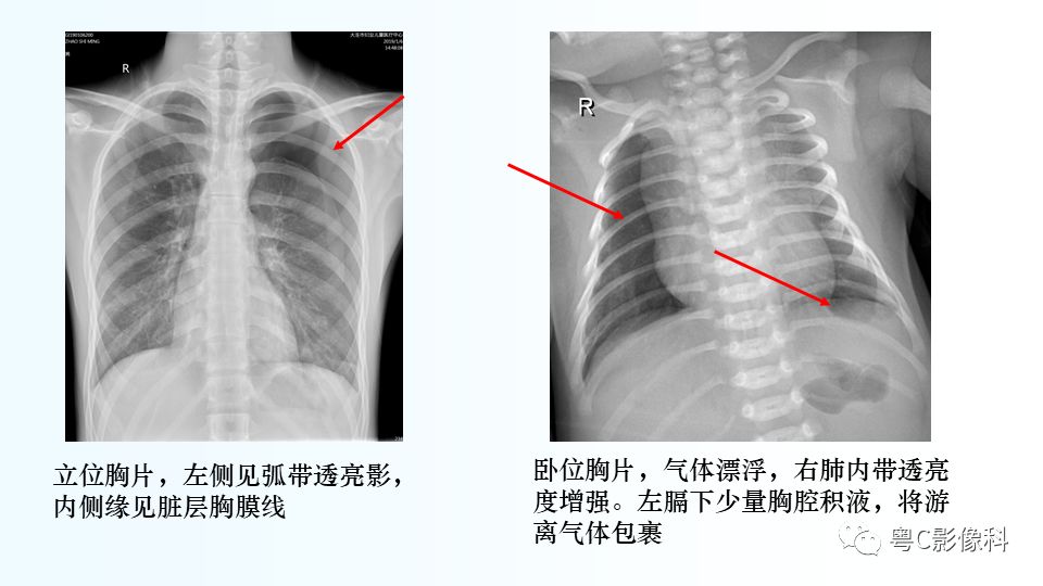 【PPT】儿童胸部影像诊断*基础病变