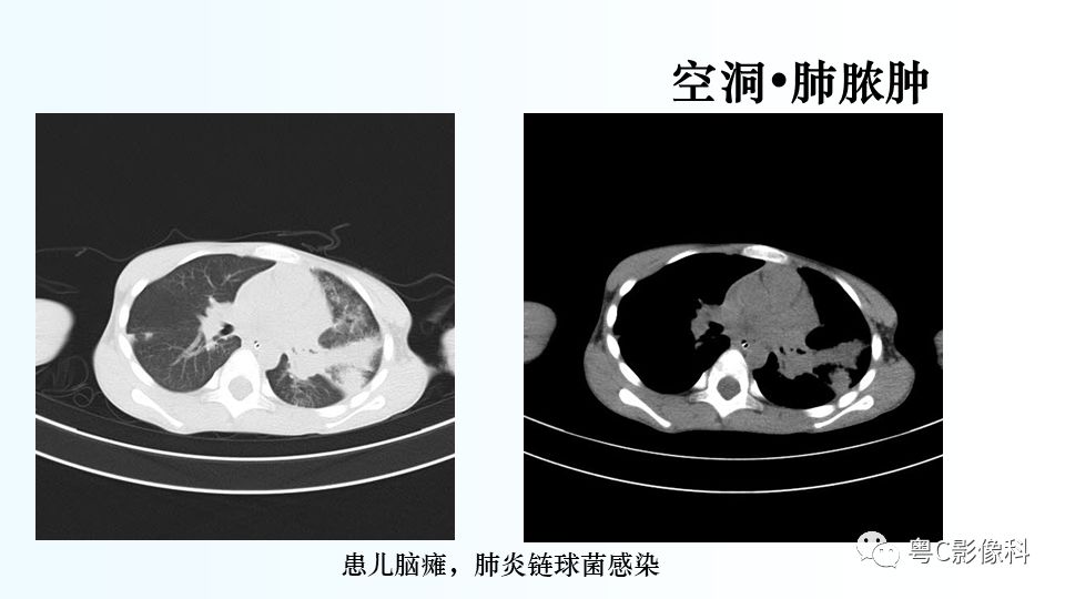 【PPT】儿童胸部影像诊断*基础病变
